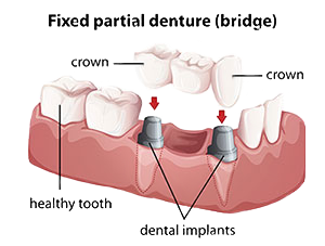 Dental Bridges | Roslindale Village Dental | Roslindale, MA 02131 | Aliakbar Esmaeili DDS