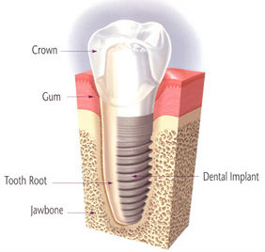 Single Tooth Implants | Roslindale Village Dental | Roslindale, MA 02131 | Aliakbar Esmaeili DDS