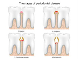 Periodontal Therapy | Roslindale Village Dental | Roslindale, MA 02131 | Aliakbar Esmaeili DDS