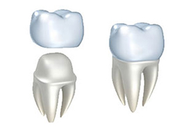 Porcelain Crowns | Roslindale Village Dental | Roslindale, MA 02131 | Aliakbar Esmaeili DDS