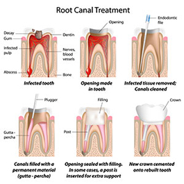 Root Canal Therapy | Roslindale Village Dental | Roslindale, MA 02131 | Aliakbar Esmaeili DDS